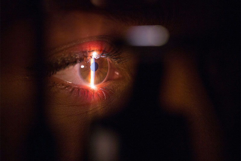 Tratamiento del glaucoma